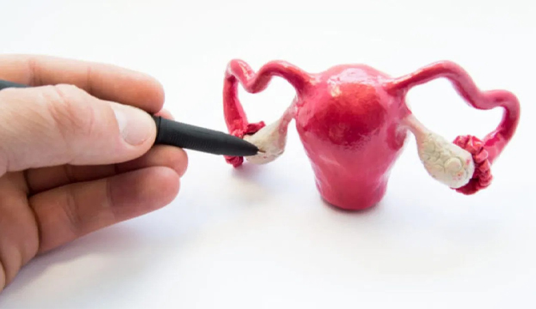 Síndrome dos ovários policísticos